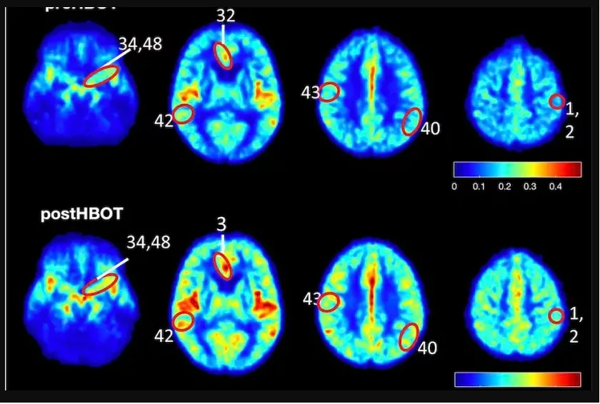 Does Brain Plasticity Increase After a Head Injury?