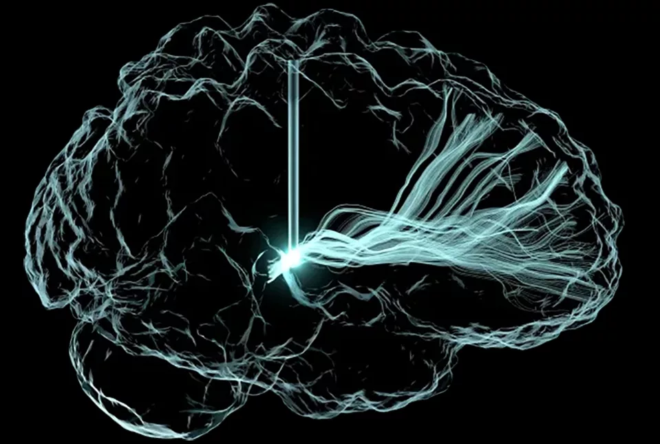 Deep Brain Stimulation Improves Cognition After Brain Injury